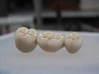 stomatology_metallokeramika Сколько стоит зуб из металлокерамики